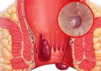 Wie sind Hämorrhoiden